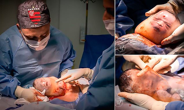 Pecah Ketuban Gagal, Bayi Lahir Terbungkus Plasenta Meski Operasi Caesar